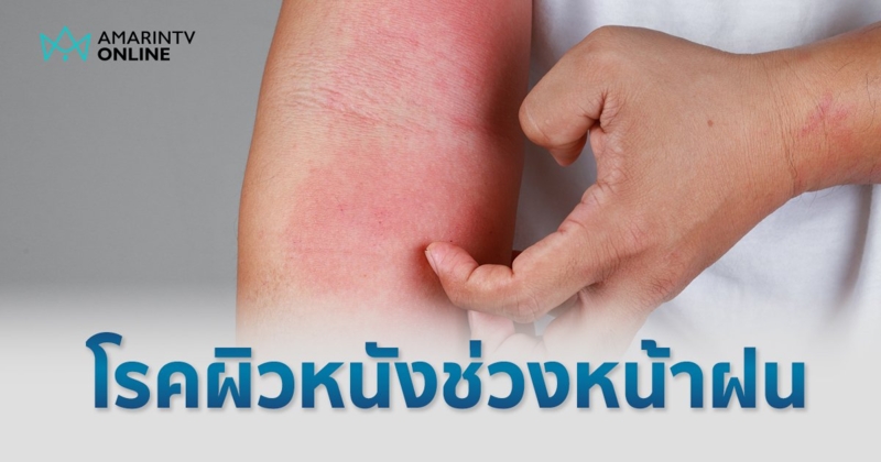 หน้าฝนทำร้ายผิว ส่อง 5 โรคผิวหนังยอดฮิตที่ต้องระวัง