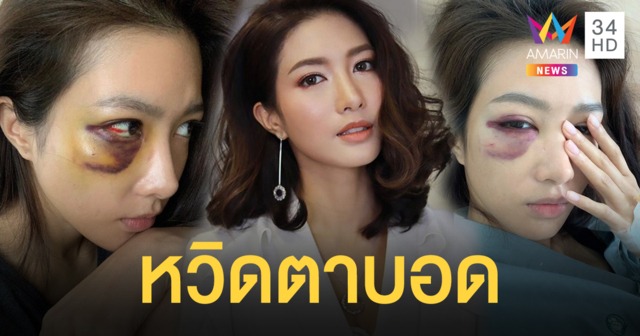 “ไอซ์ อธิชนัน” ชวดงานโกอินเตอร์ หลังอุบัติเหตุในกองถ่ายทำเส้นเลือดในตาแตก กระดูกร้าว ตาขาวถลอก