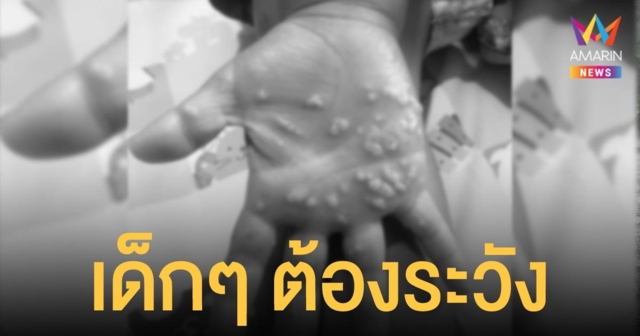 หมอเตือนคนมีลูกเล็ก ต้องระวังปล่อยให้เล่นดินทราย ติดเชื้อแบคทีเรีย จนมือเป็นหนอง