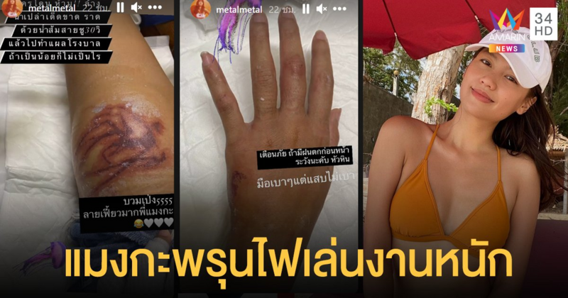 ฟาดเคราะห์ "เมทัล" โชว์บาดแผลรุนแรง เจอพิษแมงกะพรุนไฟ เตือนอย่าเล่นน้ำหลังฝนตก
