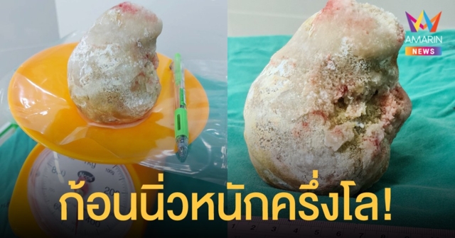 หมอเผยเรื่องช็อก ผู้ป่วยชายเจอก้อนนิ่วในทางเดินปัสสาวะ หนักครึ่งกิโลกรัม!