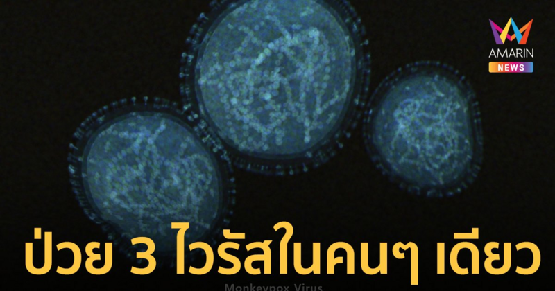 พบเคสแรก! ชายป่วยฝีดาษลิง โควิด และ HIV-1 พร้อมกันในคนๆ เดียว
