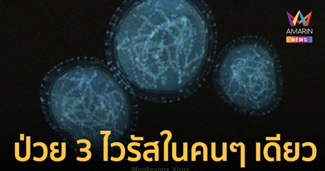 พบเคสแรก! ชายป่วยฝีดาษลิง โควิด และ HIV-1 พร้อมกันในคนๆ เดียว