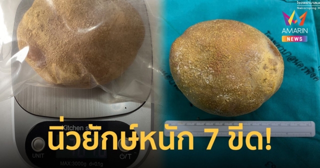 ผงะ! ลุงปวดท้องน้อยหลายเดือน ไปหาหมอตรวจเจอ 