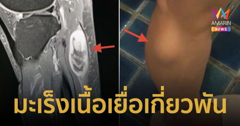 หมอเตือน! เจอก้อนเนื้อที่แขน ขาอย่าชะล่าใจ อาจเป็น "มะเร็ง"