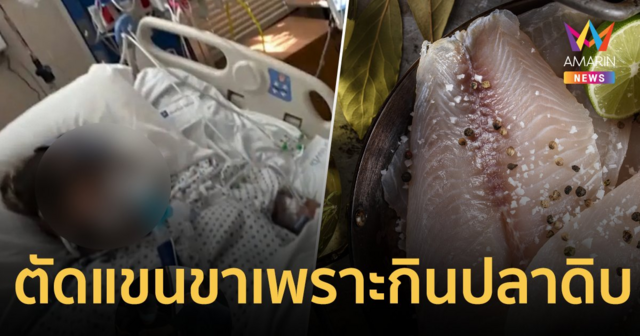 สาวใหญ่วัย 40 ปี ถูกตัดแขนขาทิ้งทั้ง 2 ข้าง หลังกินปลานิลปรุงไม่สุก