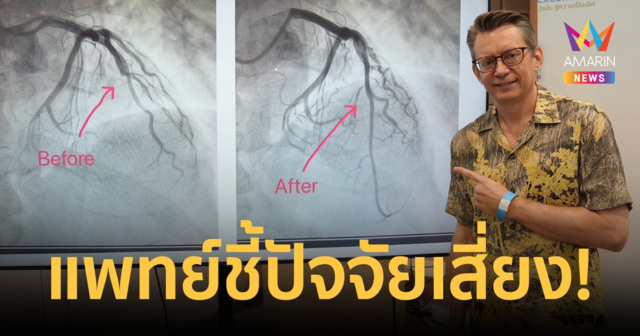 "โจนัส" ผ่าตัดบอลลูนหัวใจ แพทย์ชี้ปัจจัยเสี่ยง 'ไขมันสูง - อายุ 40 ขึ้นไป'