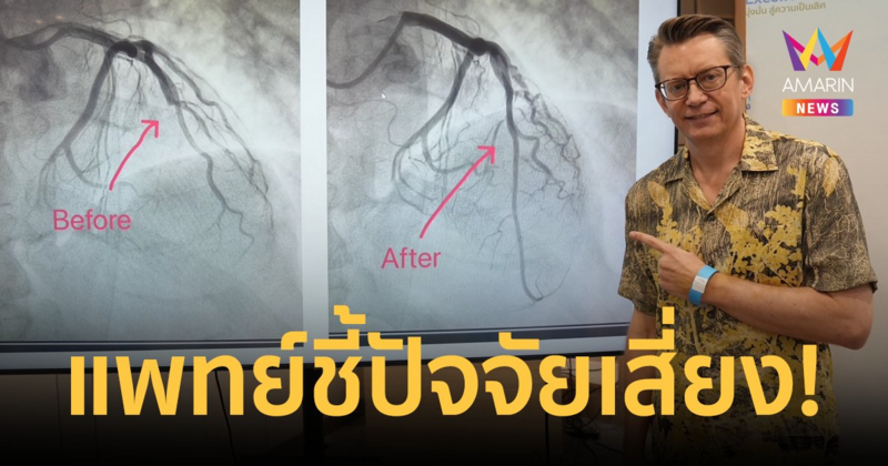 "โจนัส" ผ่าตัดบอลลูนหัวใจ แพทย์ชี้ปัจจัยเสี่ยง 'ไขมันสูง - อายุ 40 ขึ้นไป'
