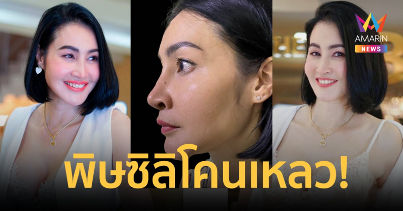 เกือบเสียโฉม! "ษา วรรณษา" เจอพิษซิลิโคนเหลว ทรมานนานนับ 10 ปี