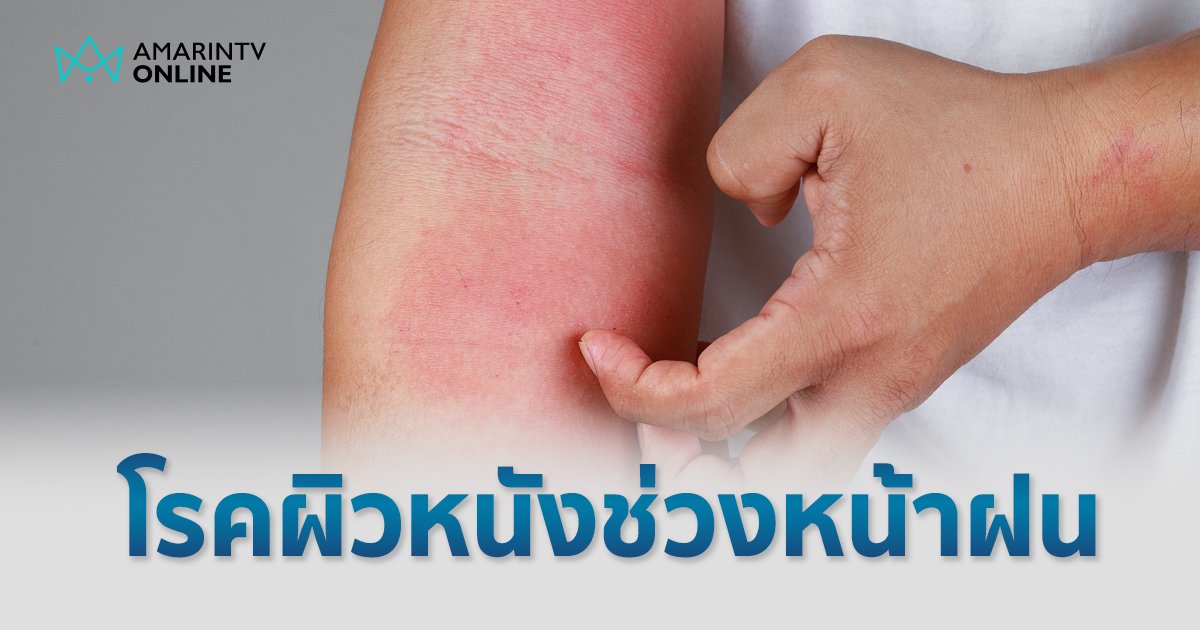 หน้าฝนทำร้ายผิว ส่อง 5 โรคผิวหนังยอดฮิตที่ต้องระวัง