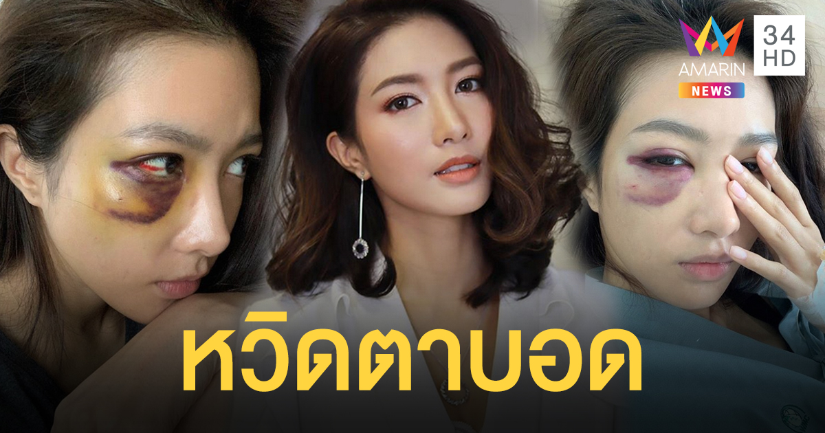 “ไอซ์ อธิชนัน” ชวดงานโกอินเตอร์ หลังอุบัติเหตุในกองถ่ายทำเส้นเลือดในตาแตก กระดูกร้าว ตาขาวถลอก