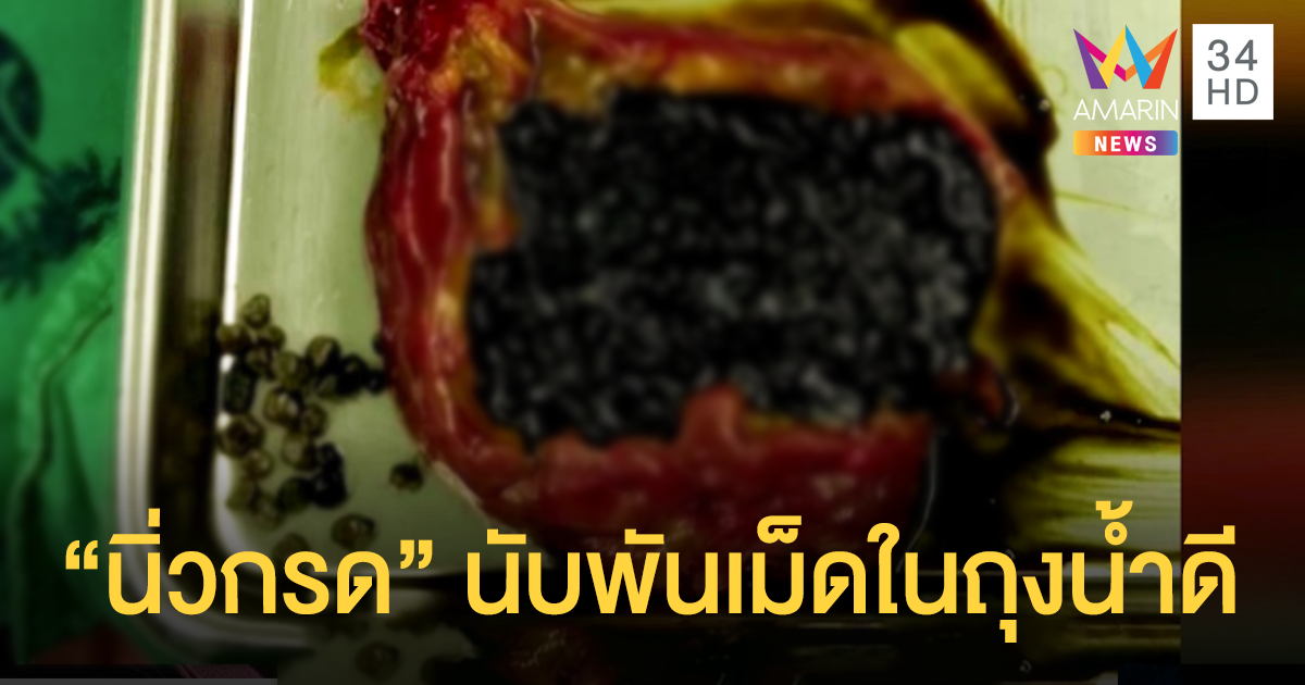หมออึ้ง! เจอ "นิ่วกรด" นับพันเม็ดในถุงน้ำดี ผ่าดูคล้าย "ชาไข่มุก"