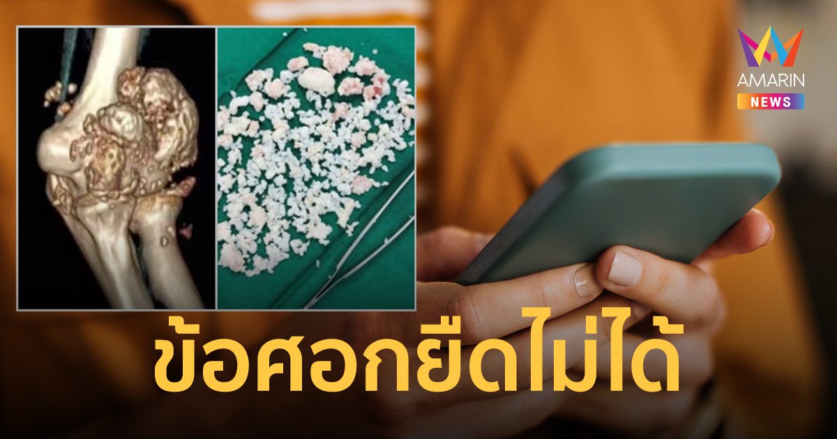 หนุ่มวัย 26 เล่นมือถือวันละ 10 ชั่วโมง ตรวจเจอเม็ดประหลาดในข้อศอกหมอบอกเป็นโรคหายาก!