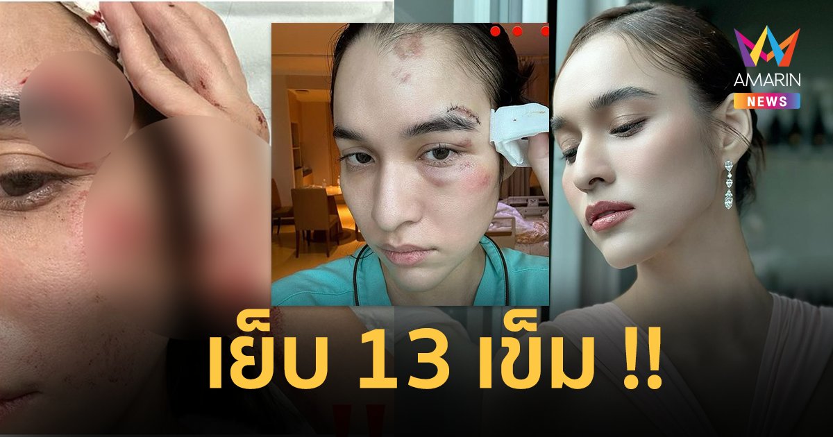 “หยาดทิพย์” เครียดหนักจนน็อก ล้มหัวแตกเย็บ 13 เข็ม หน้าเป็นแผล 9 เดือน