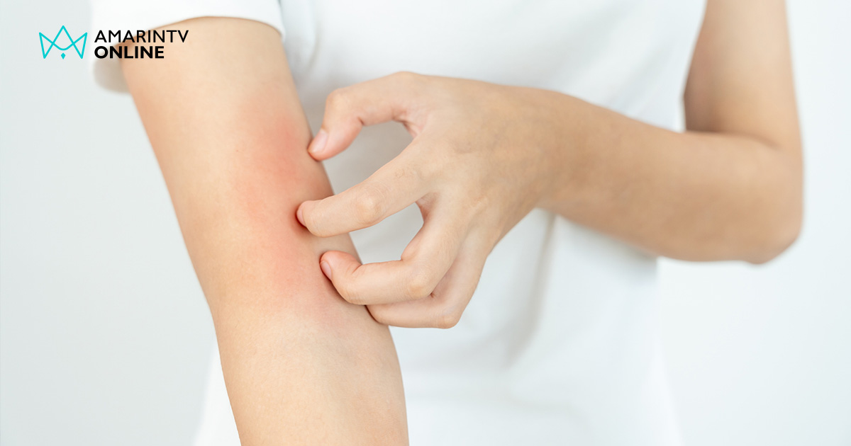 โรค SLE โรคแพ้ภูมิตัวเอง สัญญาณความผิดปกติที่ควรรีบพบแพทย์